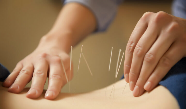 Acupuncturist